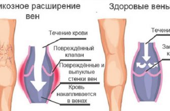 Чего боится варикоз: эффективные народные методы лечения