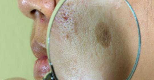 7 естественных способов лечения и удаления пятен на лице