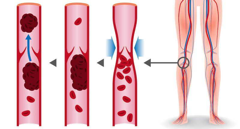 8 продуктов, которые разжижают кровь и способны предотвратить тромбоз