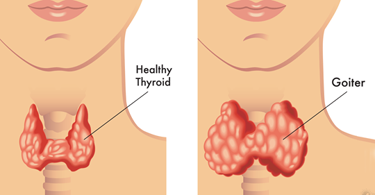 7 жизненно важных изменений, которые могут помочь улучшить состояние щитовидной железы