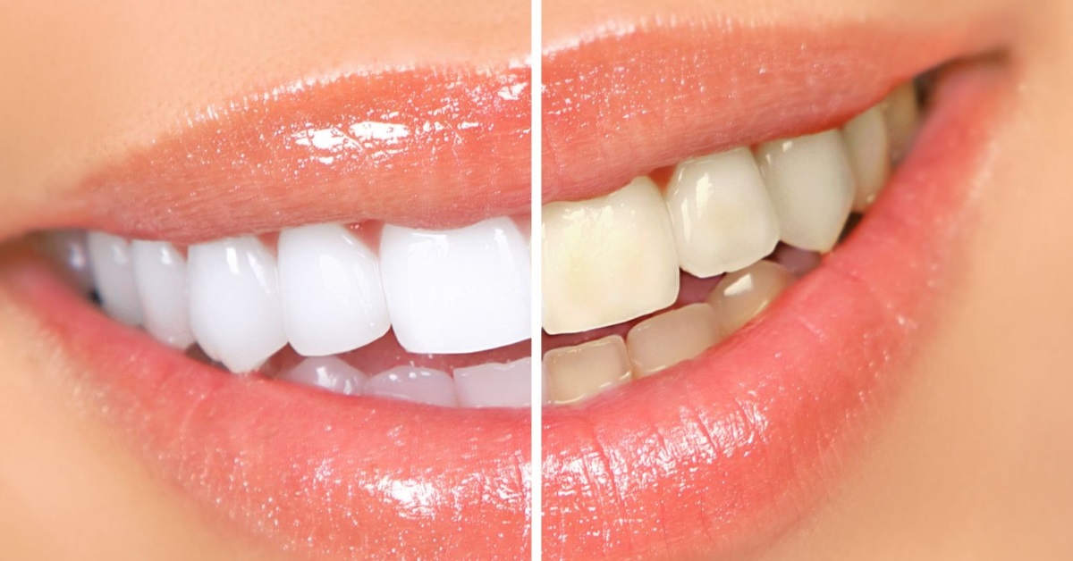 Как отбеливать желтые зубы за 2 минуты естественным способом