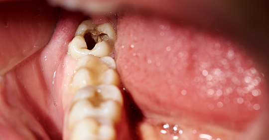 9 естественных способов предотвращения кариеса и облегчения боли в зубах