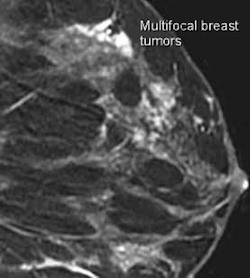 Как выглядит рак молочной железы на маммограмме?