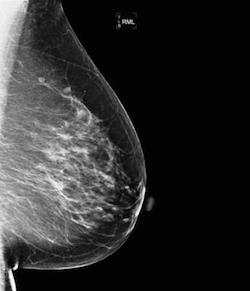 Как выглядит рак молочной железы на маммограмме?