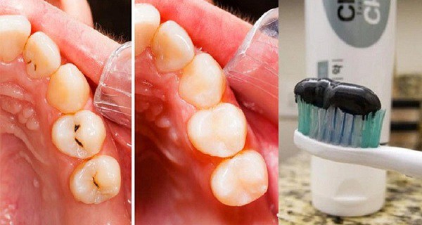 Новая зубная паста – оставила стоматологов без работы!