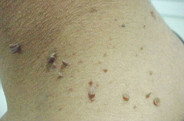 Избавься от папиллом и бородавок навсегда! Это средство есть у каждого дома!