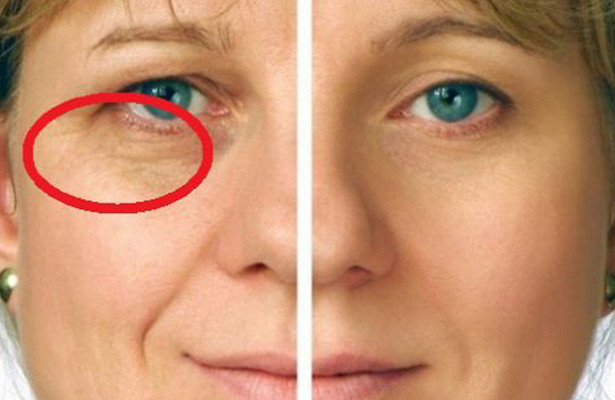 Узнай, какие ингредиенты нужно смешивать для маски от мимических морщин. 4 суперрецепта!