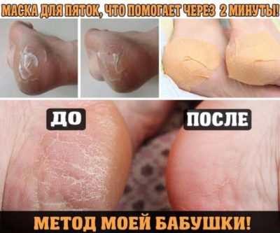 МАСКА ДЛЯ ПЯТОК, ЧТО ПОМОГАЕТ ЧЕРЕЗ 2 МИНУТЫ!