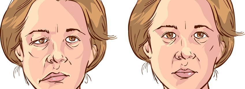 Первые признаки инсульта у женщин. Нужно действовать быстро!