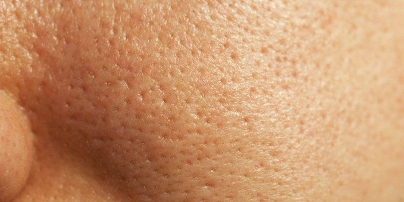 Применяй эти супер средства и за 3 дня все открытые поры исчезнут с вашей кожи навсегда!