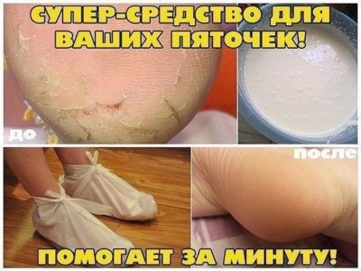 Домашнее СРЕДСТВО ДЛЯ ПЯТОК! ПОМОГАЕТ ЗА МИНУТУ! Домашнее СРЕДСТВО ДЛЯ ПЯТОК! ПОМОГАЕТ ЗА МИНУТУ!