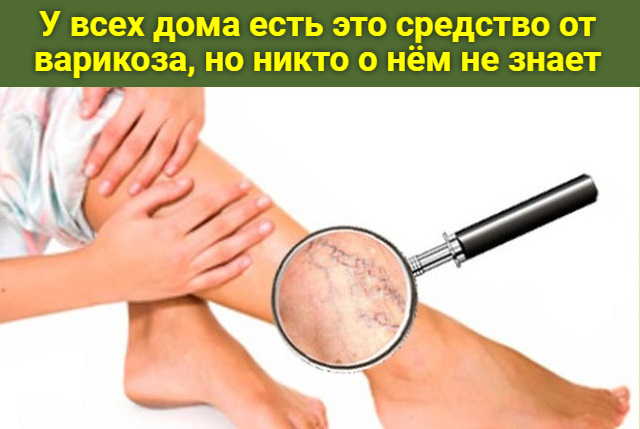 У всех дома есть это средство от варикоза но никто о нем не знает