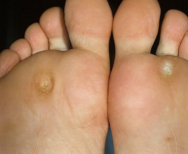 Как быстро и эффективно избавиться от натоптышей на ногах