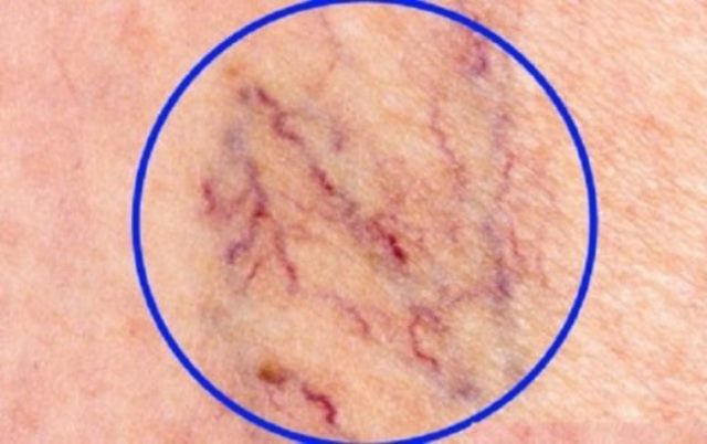 Уничтожаем «СОСУДИСТЫЕ ЗВЕЗДОЧКИ» на ногах без операций и лекарств!