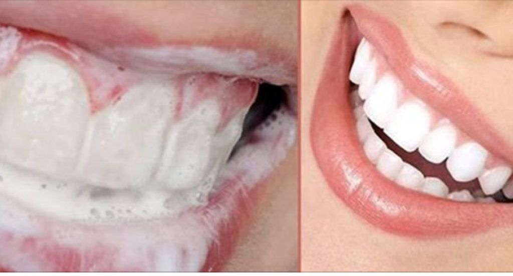 Как избавиться от зубного камня и осветлить пожелтевшую эмаль