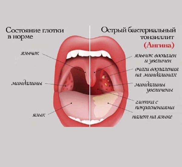 Мой фирменный рецепт от ангины.