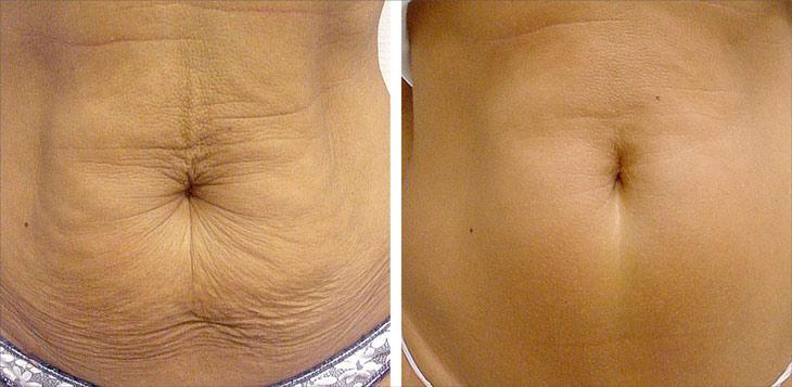 Как делать вакуум живота для похудения: отзывы, результаты и техника